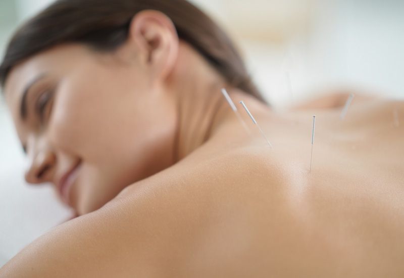 Расслабленная женщина на сеансе иглоукалывания